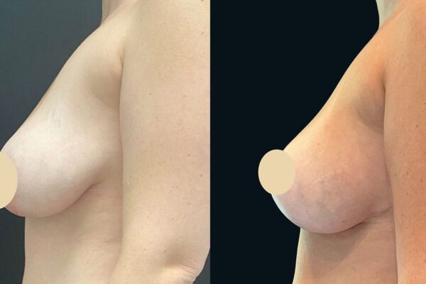 breast-rev-1-2