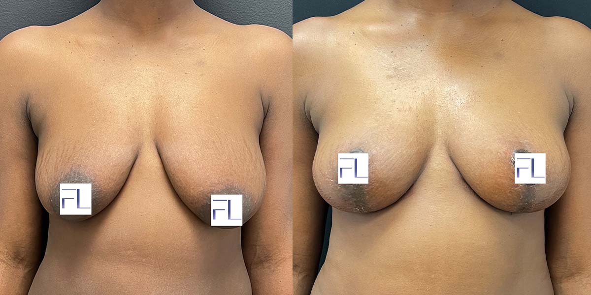 breast-lift-ba-1 Photo of patient in NYC who received a breast lift.