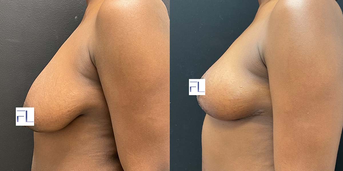 breast-lift-ba-2 Dr. Lalezar patient after a breast lift in NYC.