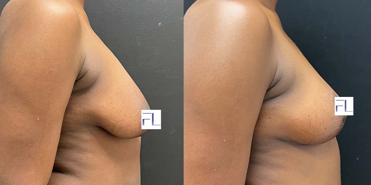 breast-lift-ba-3 Before and after of a breast lift in NYC with Dr. Lalezar.