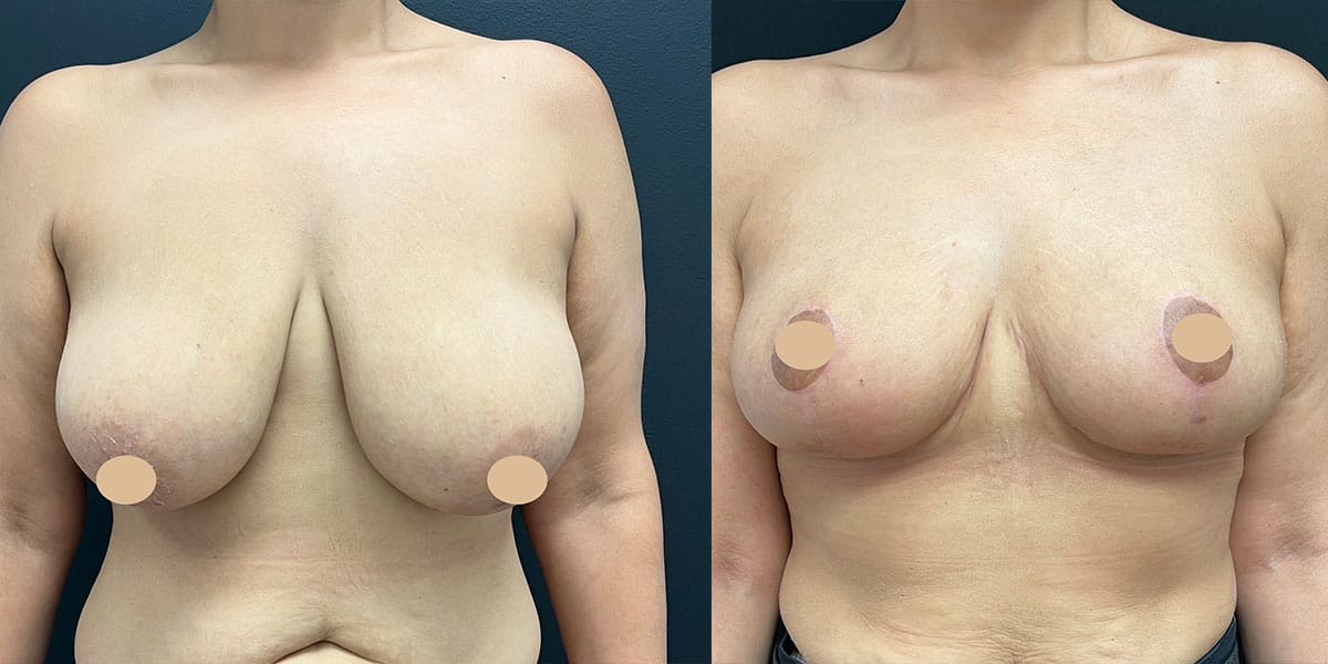 breast-lift-ba-4 Woman in NYC who received a breast lift.