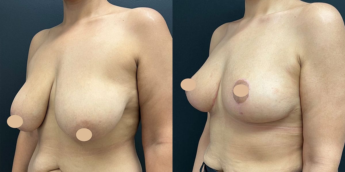 breast-lift-ba-5 Results from breast lift in NYC with Dr. Lalezar.