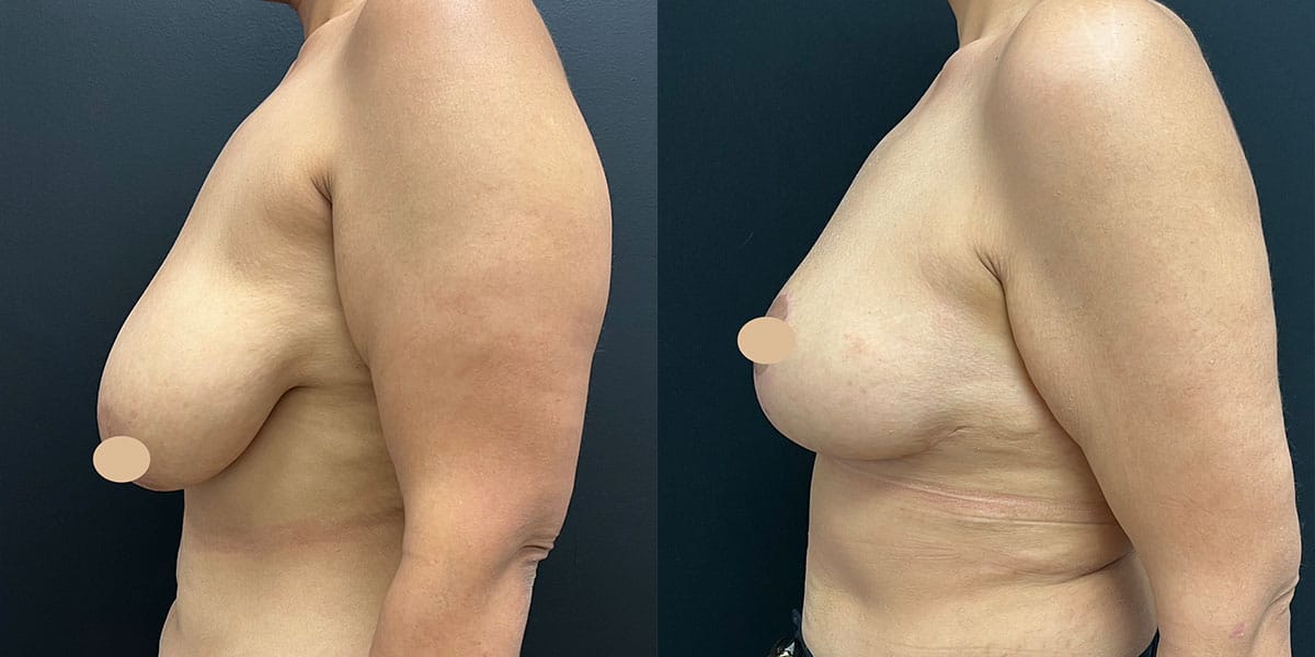 breast-lift-ba-6 Before and after photo of woman who received a breast lift in NYC.