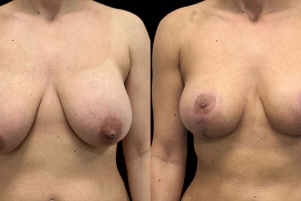 breast-revision-3-1