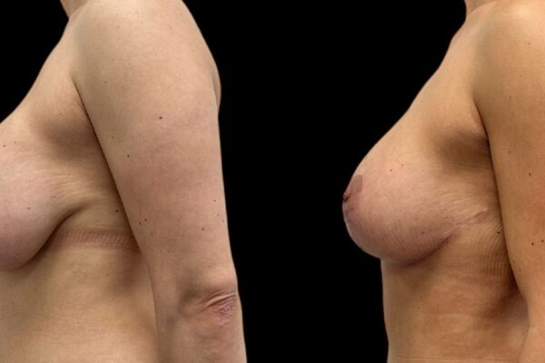 breast-revision-3-2