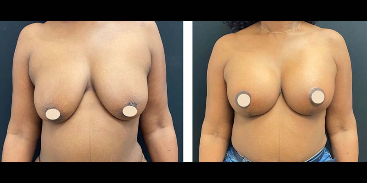 breast-aug-lift-subpage-2b