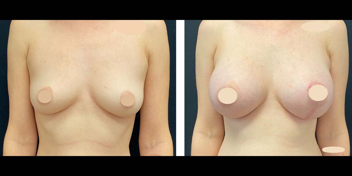 breast-aug-lift-subpage-3b