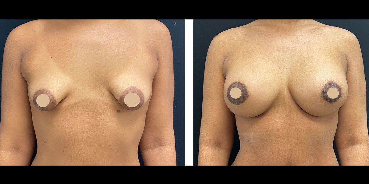 breast-aug-lift-subpage-4b